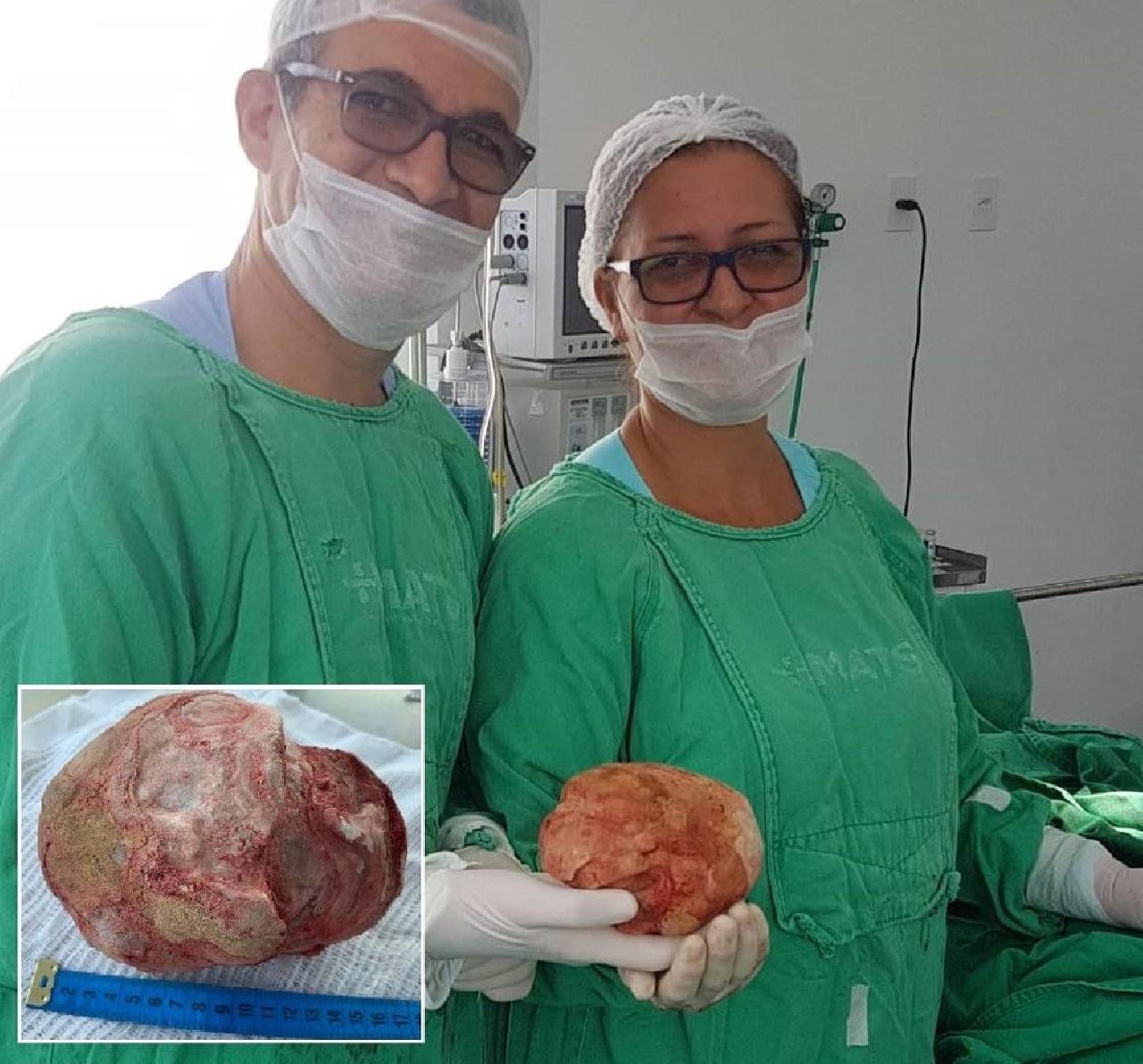 BAHIA: CIRURGIA REMOVE PEDRA DE 1,3KG E 18 CM DA BEXIGA DE UM LAVRADOR